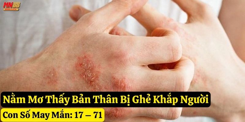 nằm mơ thấy bị ghẻ mn88